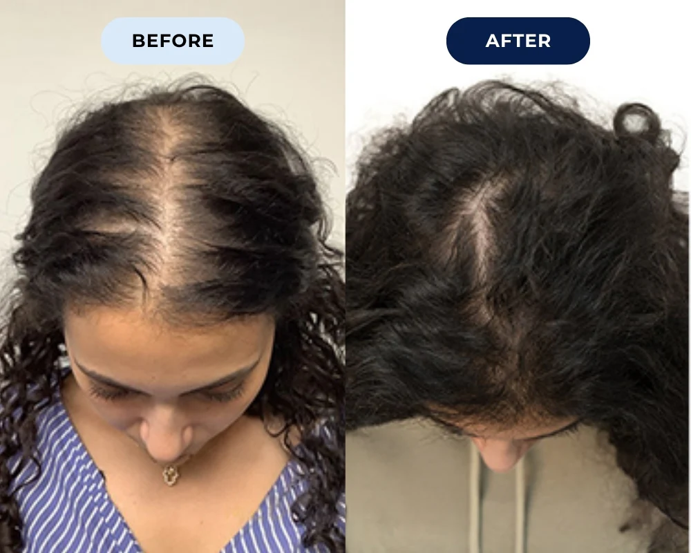 Before and after hair growth result 1