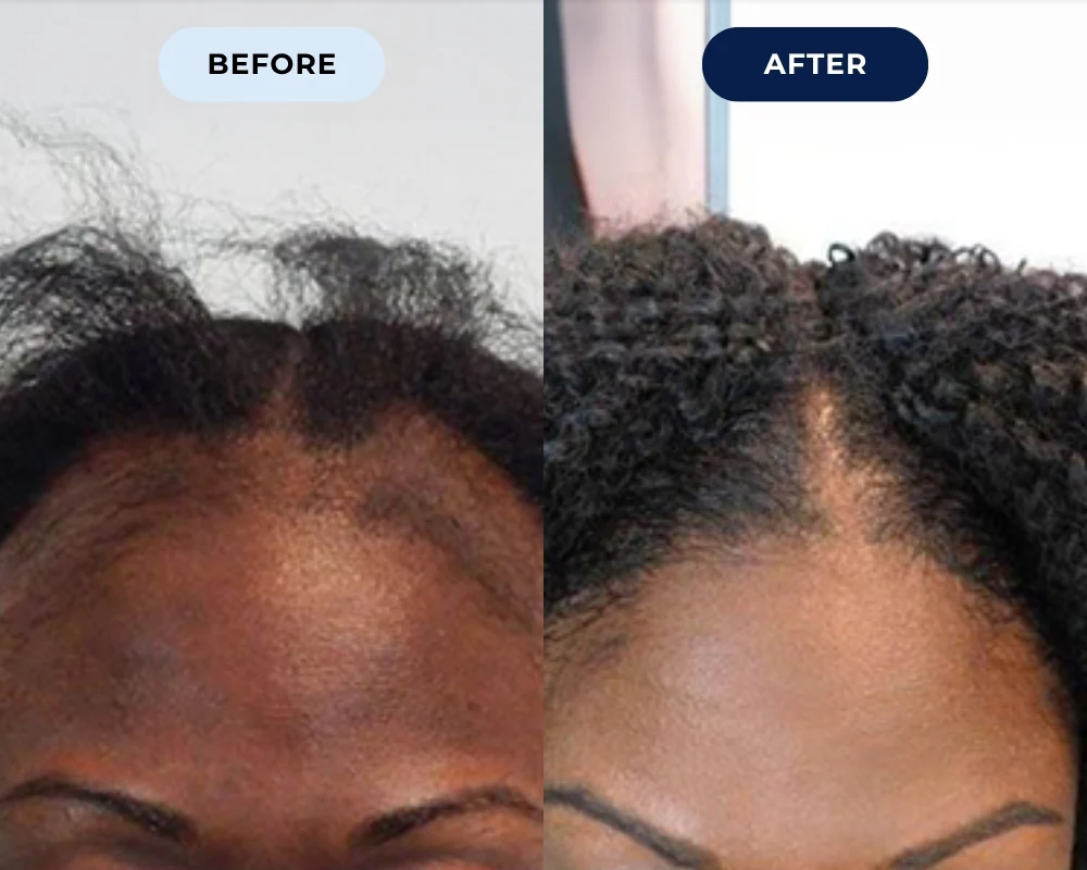 Before and after hair growth result 2