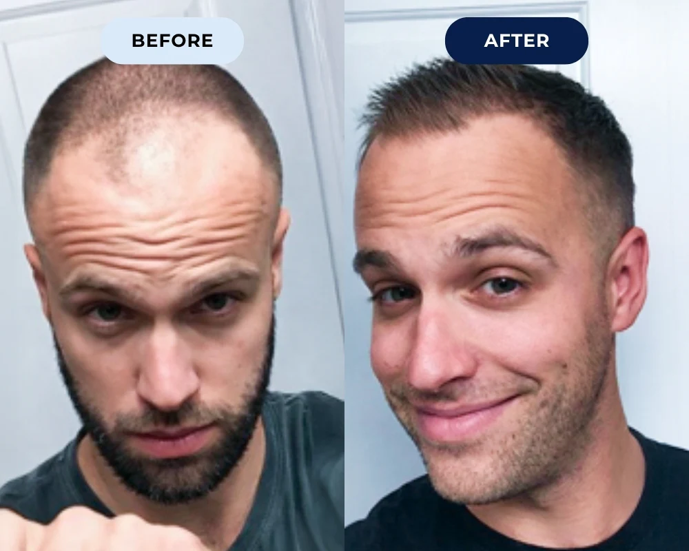 Before and after hair growth result 3