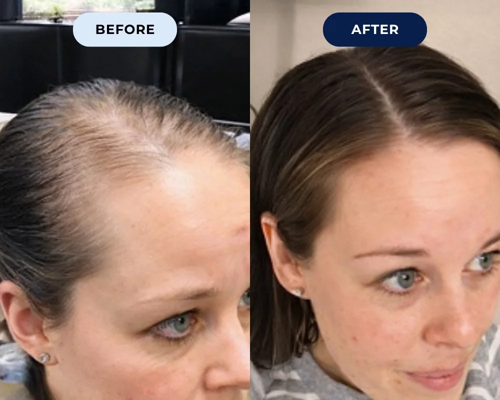 Before and after hair growth result 4