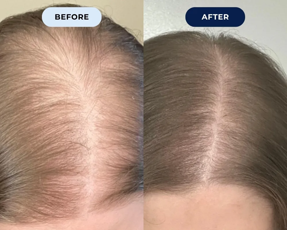 Before and after hair growth result 5