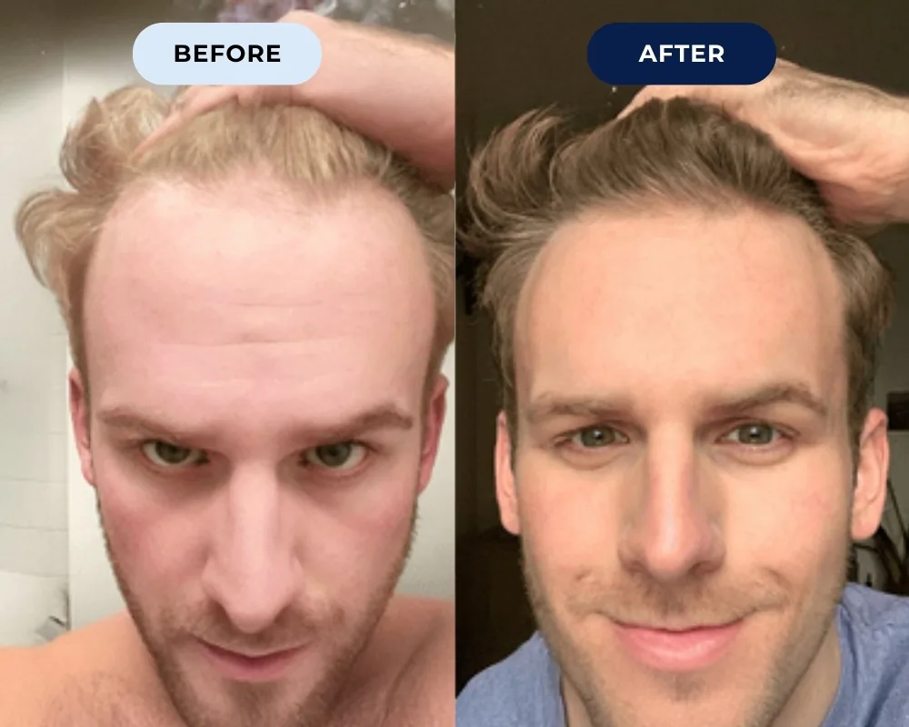 Before and after hair growth result 6