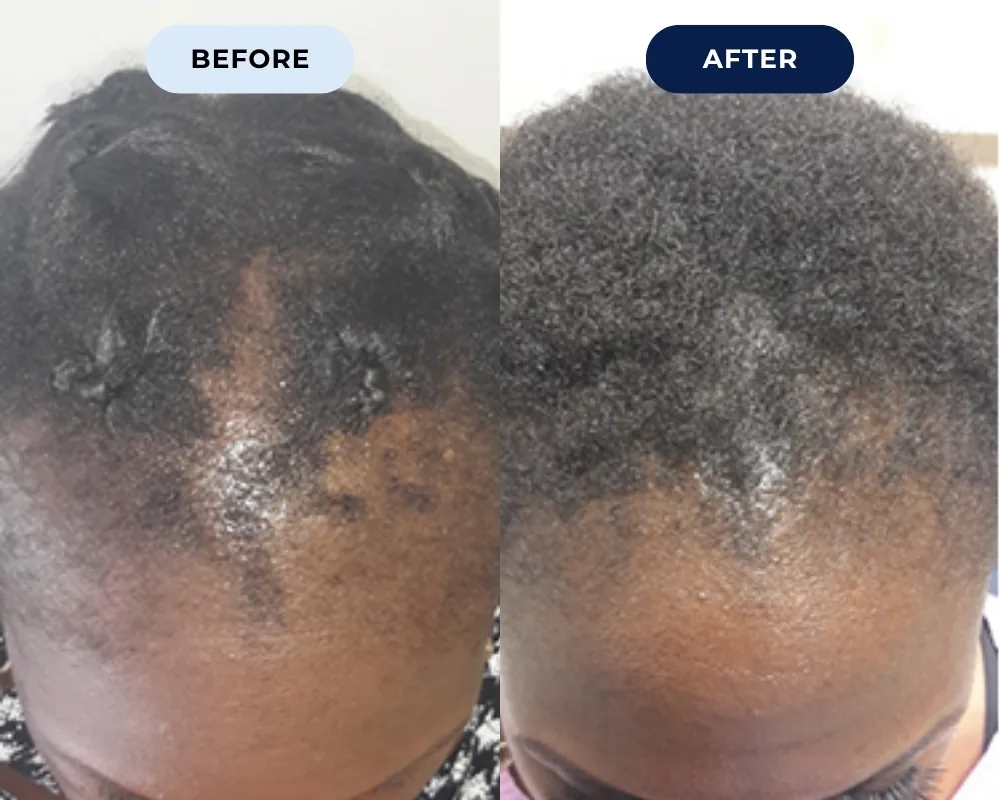 Before and after hair growth result 7
